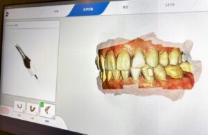 マウスピース型矯正装置、SureSmile(シュアスマイル)なら、港区赤坂・溜池山王の歯医者、寺西歯科医院まで。