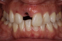 前歯部1歯欠損症例 Before