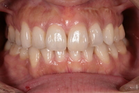 前歯部1歯欠損症例 After